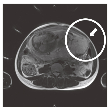 Unexpected placenta accreta spectrum after the use of assisted reproductive technology in women with adenomyomectomy.