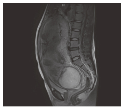 Unexpected placenta accreta spectrum after the use of assisted reproductive technology in women with adenomyomectomy.