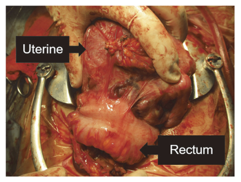 Unexpected placenta accreta spectrum after the use of assisted reproductive technology in women with adenomyomectomy.