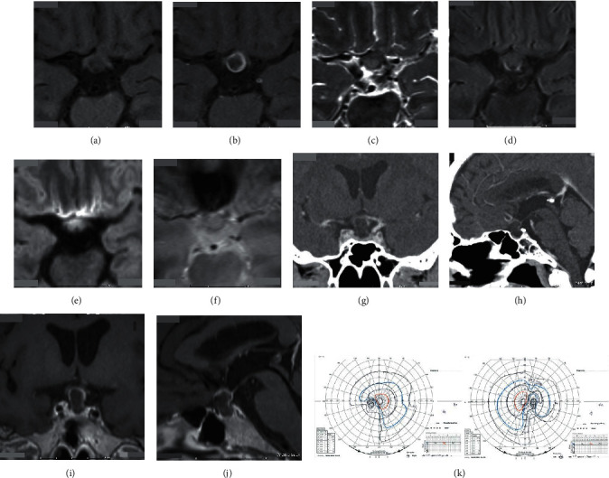 Prolonged Postoperative Pyrexia and Transient Nonnephrogenic Vasopressin-Analogue-Resistant Polyuria following Endoscopic Transsphenoidal Resection of an Infundibular Epidermoid Cyst.