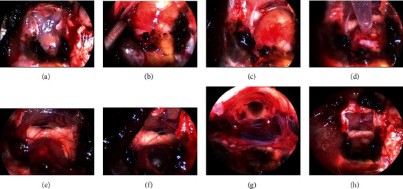 Prolonged Postoperative Pyrexia and Transient Nonnephrogenic Vasopressin-Analogue-Resistant Polyuria following Endoscopic Transsphenoidal Resection of an Infundibular Epidermoid Cyst.