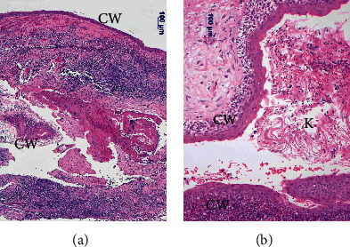 Prolonged Postoperative Pyrexia and Transient Nonnephrogenic Vasopressin-Analogue-Resistant Polyuria following Endoscopic Transsphenoidal Resection of an Infundibular Epidermoid Cyst.