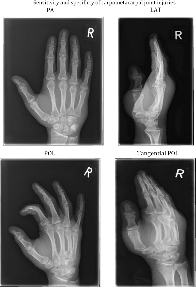 Sensitivity and Specificity of Radiographs in the Diagnosis of Little and/or Ring Carpometacarpal Joint Injuries.