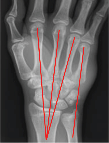 Sensitivity and Specificity of Radiographs in the Diagnosis of Little and/or Ring Carpometacarpal Joint Injuries.