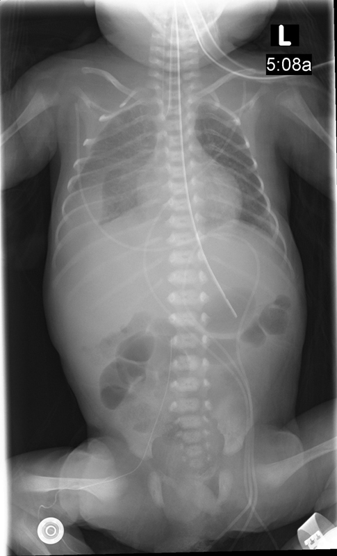 Profound Hypotonia and Respiratory Failure due to Suspected Nemaline Myopathy in a Preterm Infant.