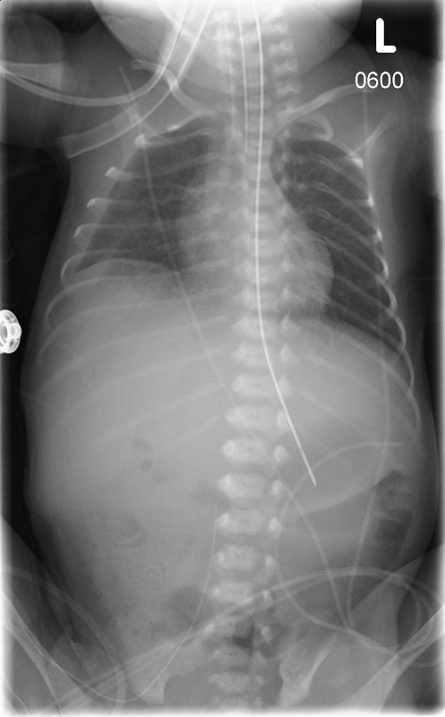 Profound Hypotonia and Respiratory Failure due to Suspected Nemaline Myopathy in a Preterm Infant.