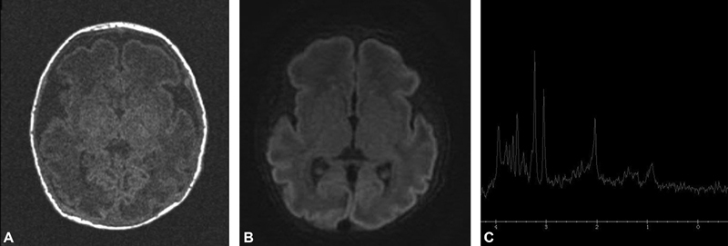 Profound Hypotonia and Respiratory Failure due to Suspected Nemaline Myopathy in a Preterm Infant.