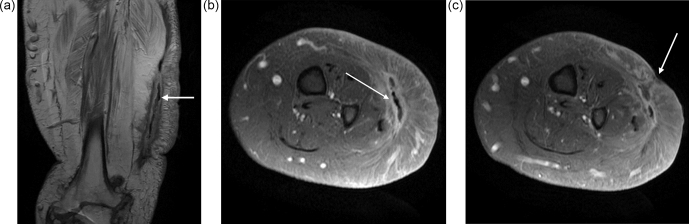 Osteomyelitis in heterotopic ossification in a patient with congenital gigantism of the leg.