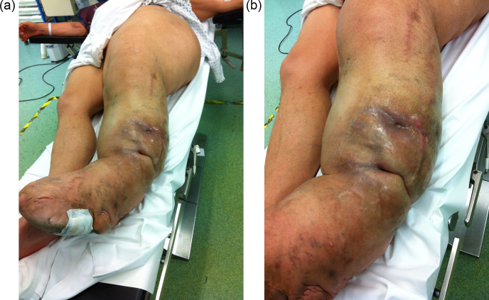 Osteomyelitis in heterotopic ossification in a patient with congenital gigantism of the leg.