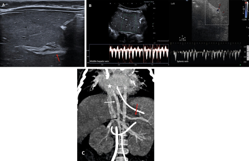 Abernethy Malformation Type 1b.