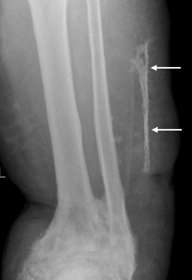 Osteomyelitis in heterotopic ossification in a patient with congenital gigantism of the leg.