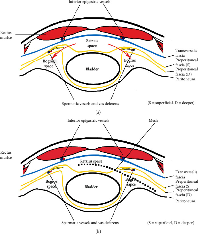 Totally Extraperitoneal Herniorrhaphy (TEP): Lessons Learned from Anatomical Observations.