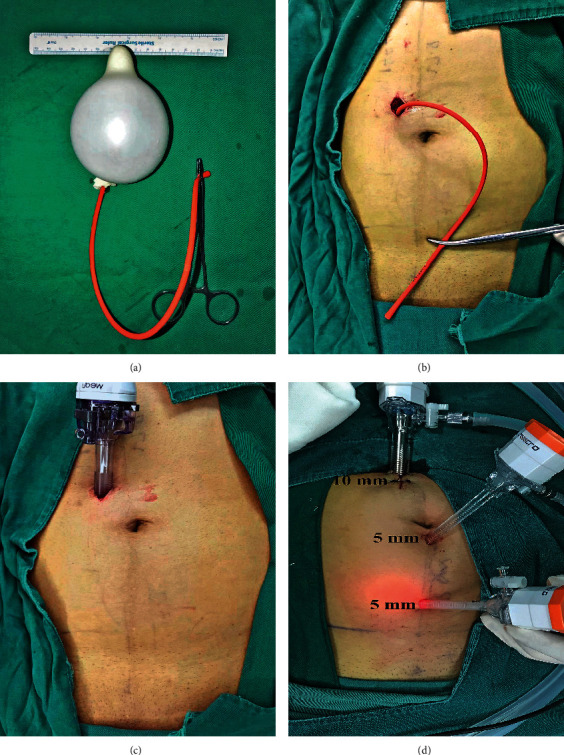 Totally Extraperitoneal Herniorrhaphy (TEP): Lessons Learned from Anatomical Observations.