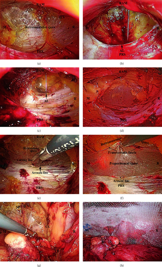 Totally Extraperitoneal Herniorrhaphy (TEP): Lessons Learned from Anatomical Observations.