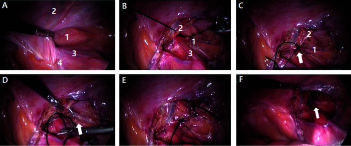 Laparoscopic Iliopubic Tract Repair with Transabdominal Preperitoneal Hernioplasty after Radical Prostatectomy.