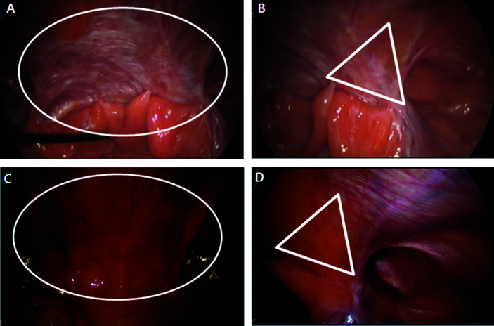 Laparoscopic Iliopubic Tract Repair with Transabdominal Preperitoneal Hernioplasty after Radical Prostatectomy.