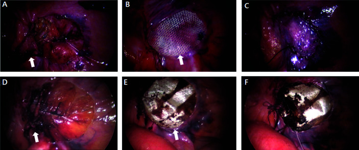 Laparoscopic Iliopubic Tract Repair with Transabdominal Preperitoneal Hernioplasty after Radical Prostatectomy.