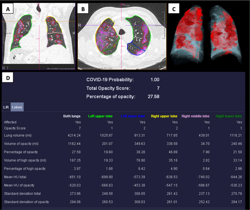 Comparing Visual Scoring of Lung Injury with a Quantifying AI-Based Scoring in Patients with COVID-19.