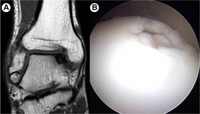 Persistent Pain After Operative Treatment for Chronic Lateral Ankle Instability.