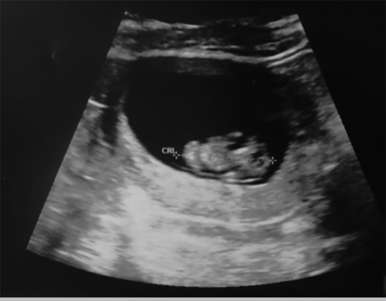 One follicle, one egg, one embryo: a case-report of successful pregnancy obtained from a single oocyte collected.