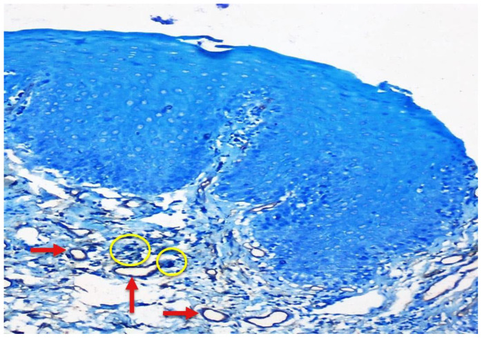 Correlation of Mast Cell and Angiogenesis in Oral Lichen Planus, Dysplasia (Leukoplakia), and Oral Squamous Cell Carcinoma.