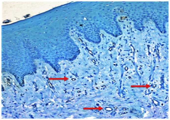 Correlation of Mast Cell and Angiogenesis in Oral Lichen Planus, Dysplasia (Leukoplakia), and Oral Squamous Cell Carcinoma.