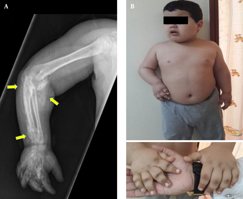 Subcutaneous Calcification and Fixed Flexion Deformity of the Right Elbow Joint in a Child with a GNAS Mutation: A Case Report.