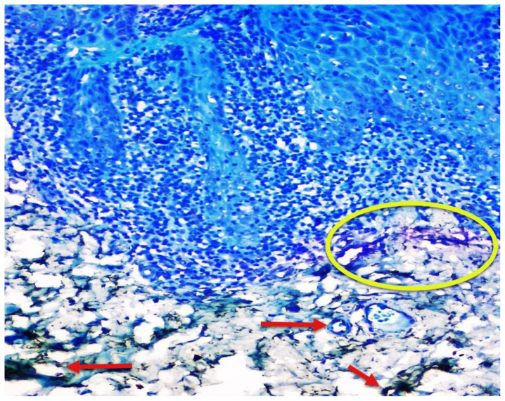 Correlation of Mast Cell and Angiogenesis in Oral Lichen Planus, Dysplasia (Leukoplakia), and Oral Squamous Cell Carcinoma.