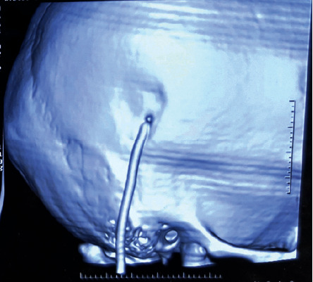 Pseudocyst in Neck: A Case Report on Rare Complication of Ventriculoperitoneal Shunt.