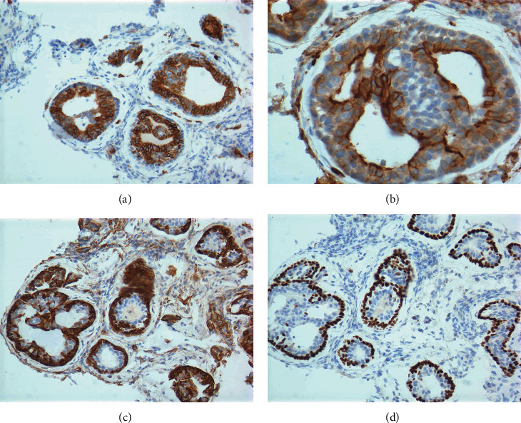 Colonic Metastasis of Adenoid Cystic Carcinoma 19 Years after the Primary Tumor Resection.