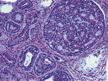 Colonic Metastasis of Adenoid Cystic Carcinoma 19 Years after the Primary Tumor Resection.