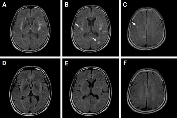 New-onset epilepsy in a patient with myelin oligodendrocyte glycoprotein antibodies.