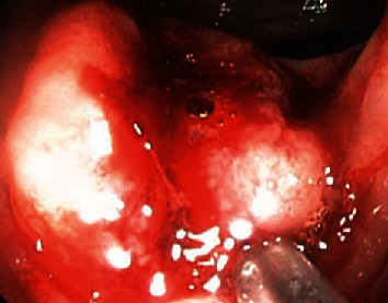 Colonic Metastasis of Adenoid Cystic Carcinoma 19 Years after the Primary Tumor Resection.