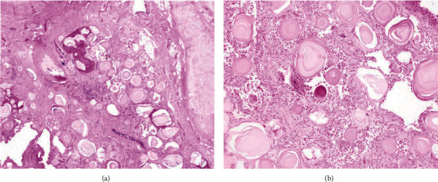 Pulmonary Alveolar Microlithiasis: A Unique Case of Familial PAM Complicated by Transplant Rejection.