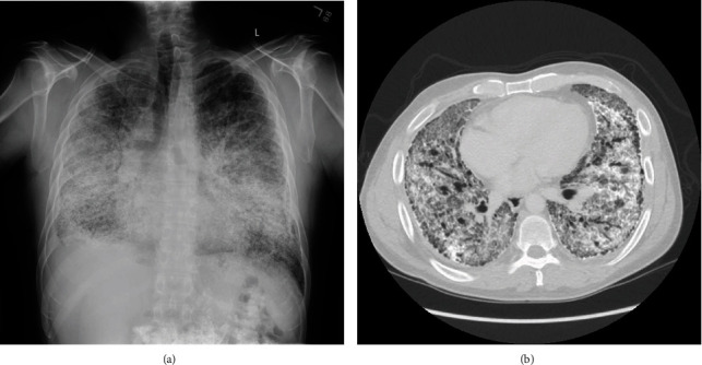 Pulmonary Alveolar Microlithiasis: A Unique Case of Familial PAM Complicated by Transplant Rejection.