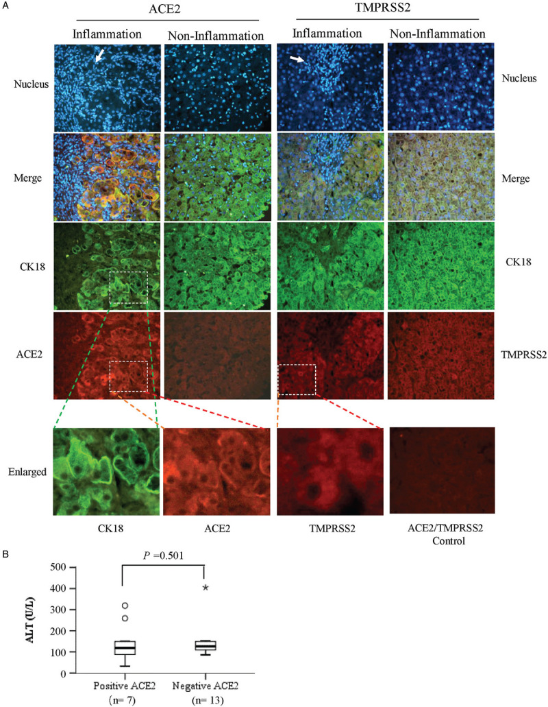ACE2 and TMPRSS2 Expression in Hepatocytes of Chronic HBV Infection Patients.
