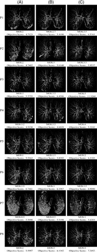 Longitudinal evaluation for COVID-19 chest CT disease progression based on Tchebichef moments