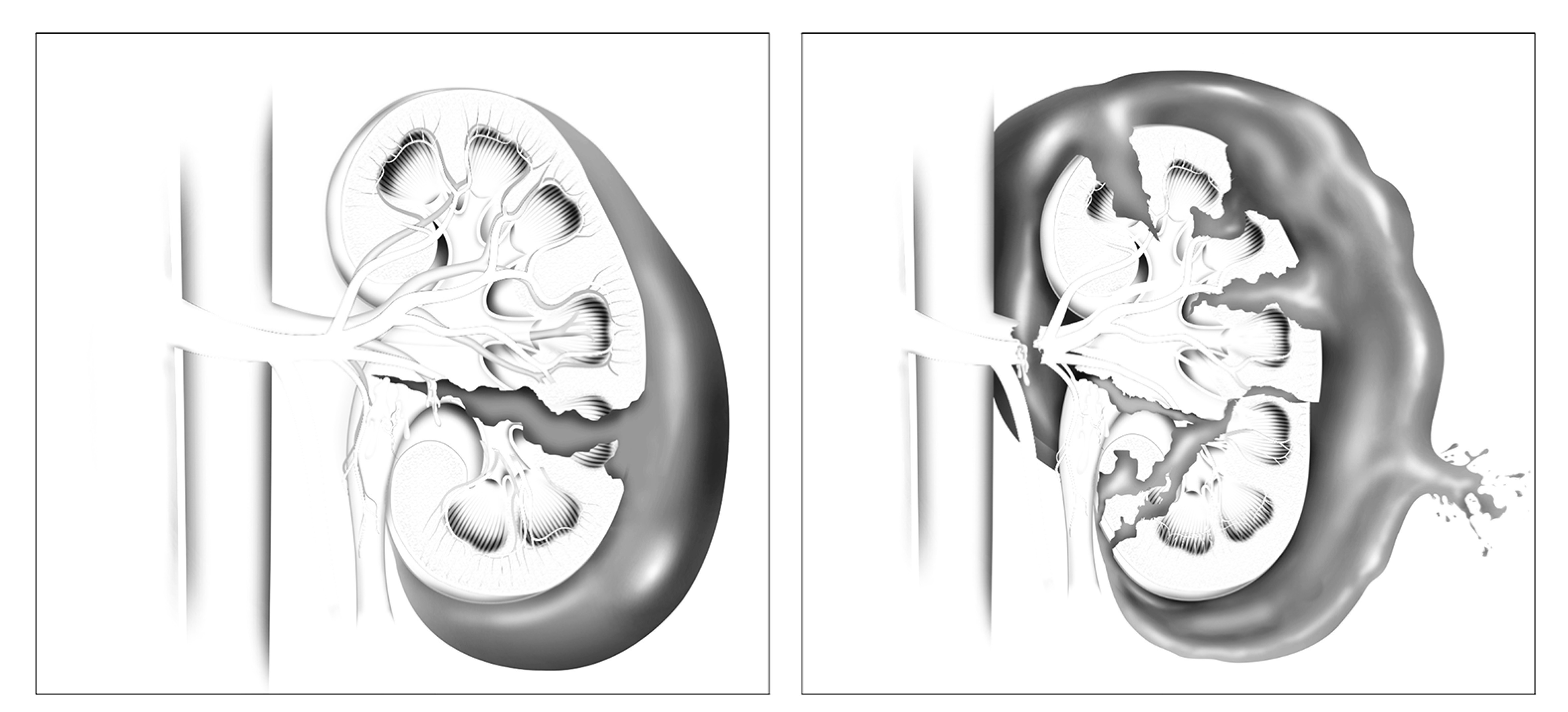 Damage Control for renal trauma: the more conservative the surgeon, better for the kidney.