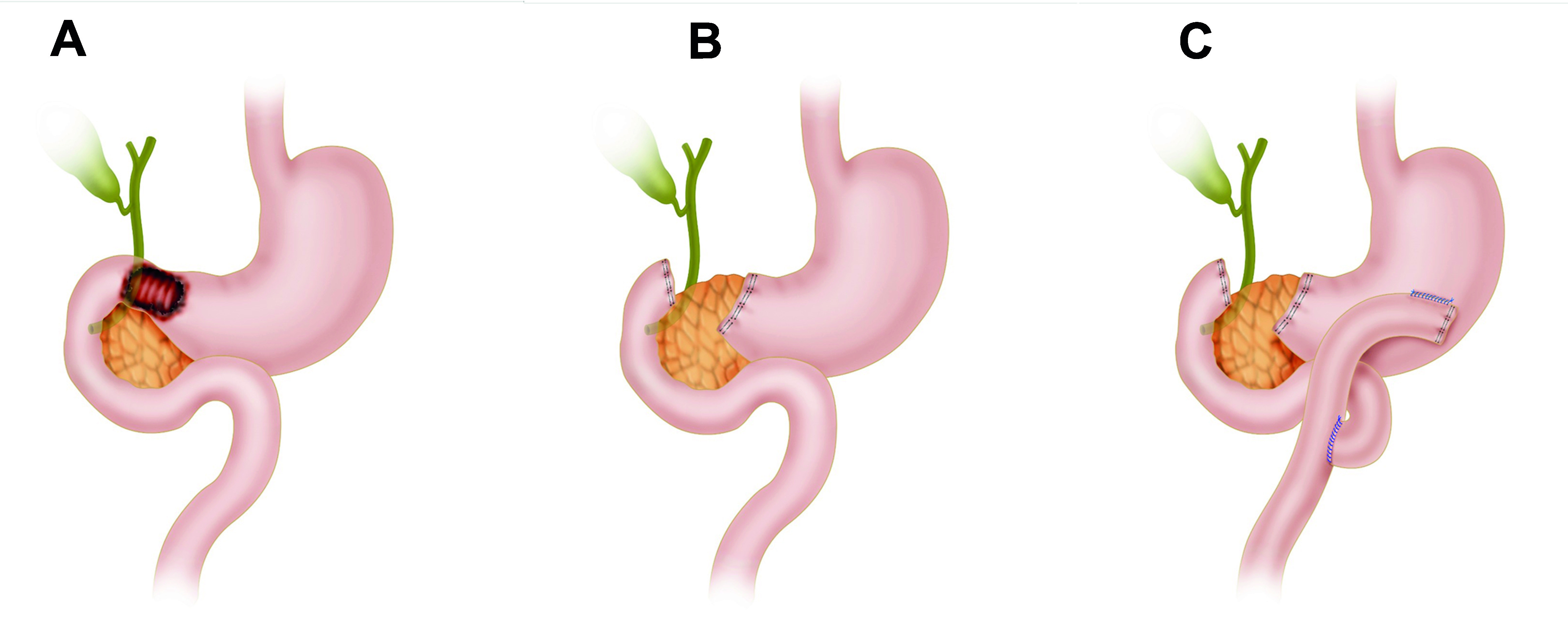 Damage control in penetrating duodenal trauma: less is better - the sequel.