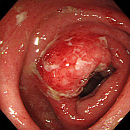 <i>Campylobacter</i> Enterocolitis: A Characteristic Shallow and Large Ulcer on the Ileocecal Valve.