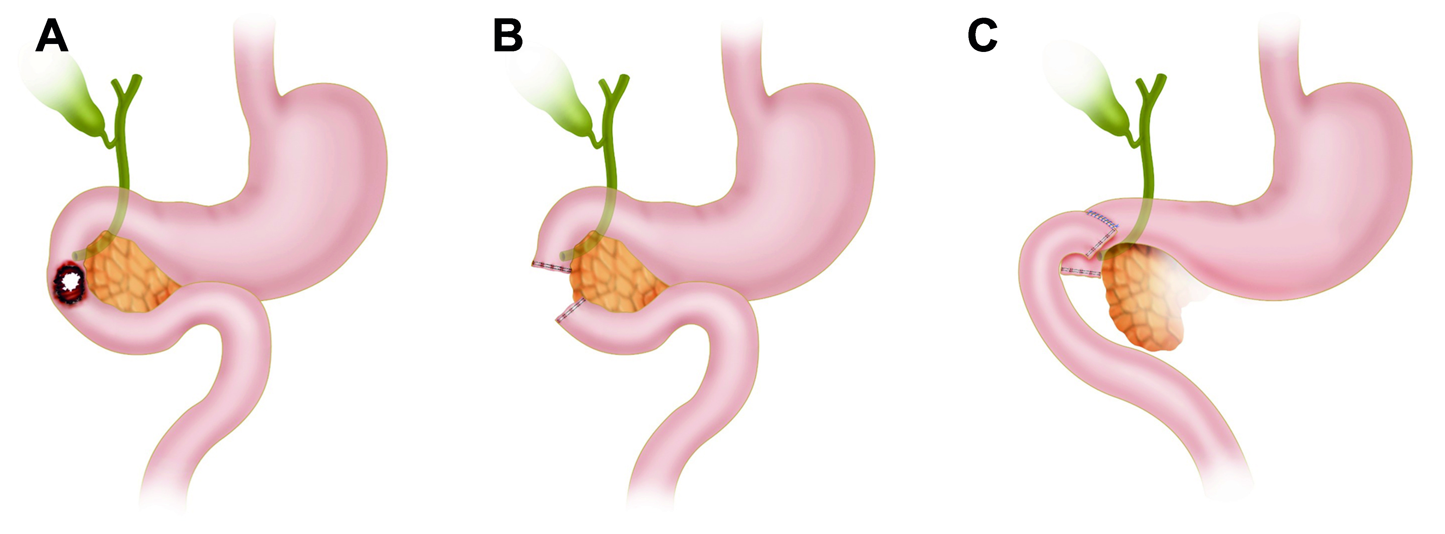 Damage control in penetrating duodenal trauma: less is better - the sequel.