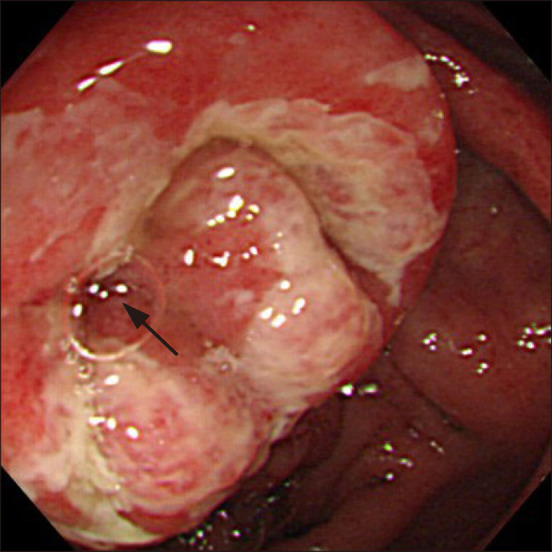 <i>Campylobacter</i> Enterocolitis: A Characteristic Shallow and Large Ulcer on the Ileocecal Valve.