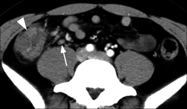 <i>Campylobacter</i> Enterocolitis: A Characteristic Shallow and Large Ulcer on the Ileocecal Valve.