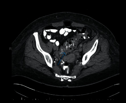 A Rare Twist of the Forgotten Disease: A Case of <i>Fusobacterium necrophorum</i> Sepsis with Portomesenteric Thrombosis and a Review of the Literature.