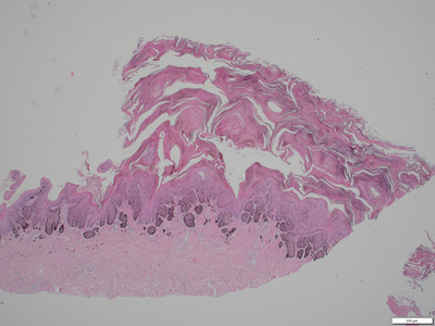 Nasal hyperkeratosis in Griffon breeds: Clinical, histopathological features and the prevalence in the Swedish population compared to a control group and other brachycephalic breeds.