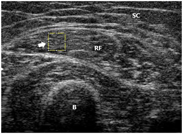 Quantitative Muscle Ultrasonography Using 2D Textural Analysis: A Novel Approach to Assess Skeletal Muscle Structure and Quality in Chronic Kidney Disease.