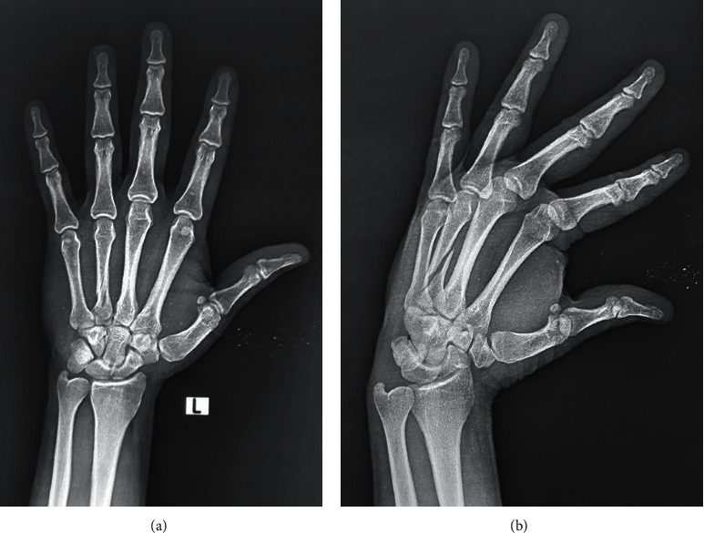 A Single Intramedullary K-Wire Is Sufficient for the Management of Nonthumb Metacarpal Shaft Fractures.