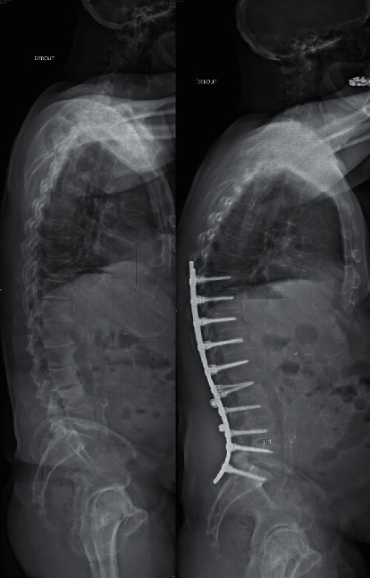 Optimal Correction of Adult Spinal Deformities Requires Restoration of Distal Lumbar Lordosis.