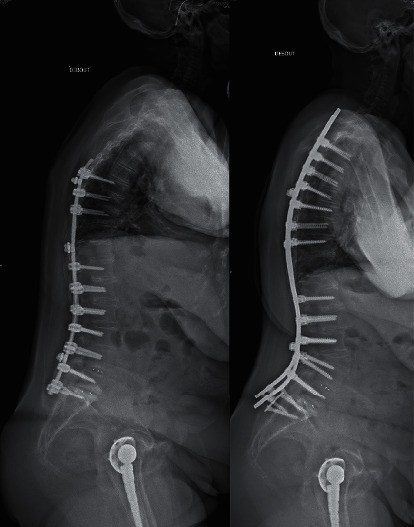 Optimal Correction of Adult Spinal Deformities Requires Restoration of Distal Lumbar Lordosis.