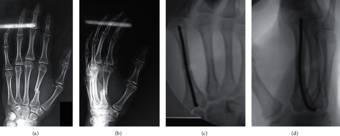 A Single Intramedullary K-Wire Is Sufficient for the Management of Nonthumb Metacarpal Shaft Fractures.